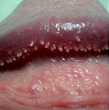 Гранулы Фордайса появляются на коже половых органов, на сосках, в паху, на слизистой оболочке рта и на губох